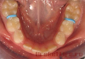 Сепарация — зубосберегающая технология в ортодонтическом лечении